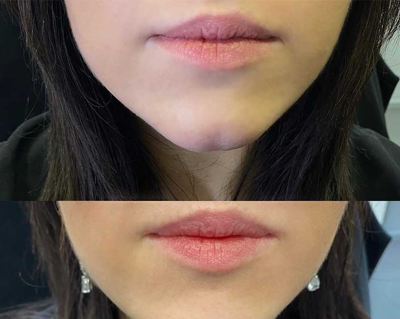 Lip fill. Фото губ. Формы губ для увеличения гиалуроновой.