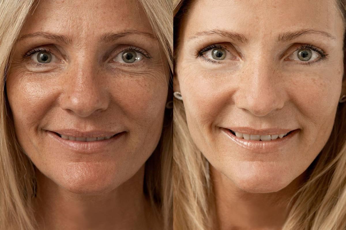 Биоревилитация это. Биоревитализация LJ B gjckt. Морщины на лице. Биоревитализация лица до и после. Женщина с морщинами.